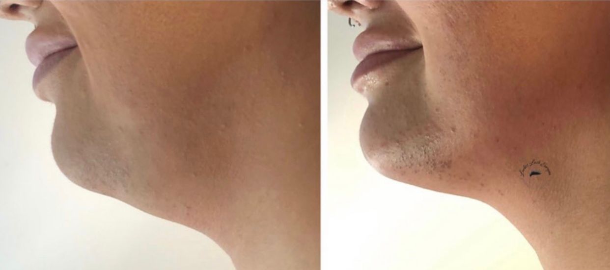 PROCEDIMENTO PAPADA OU BRAÇO 3 SESSÕES