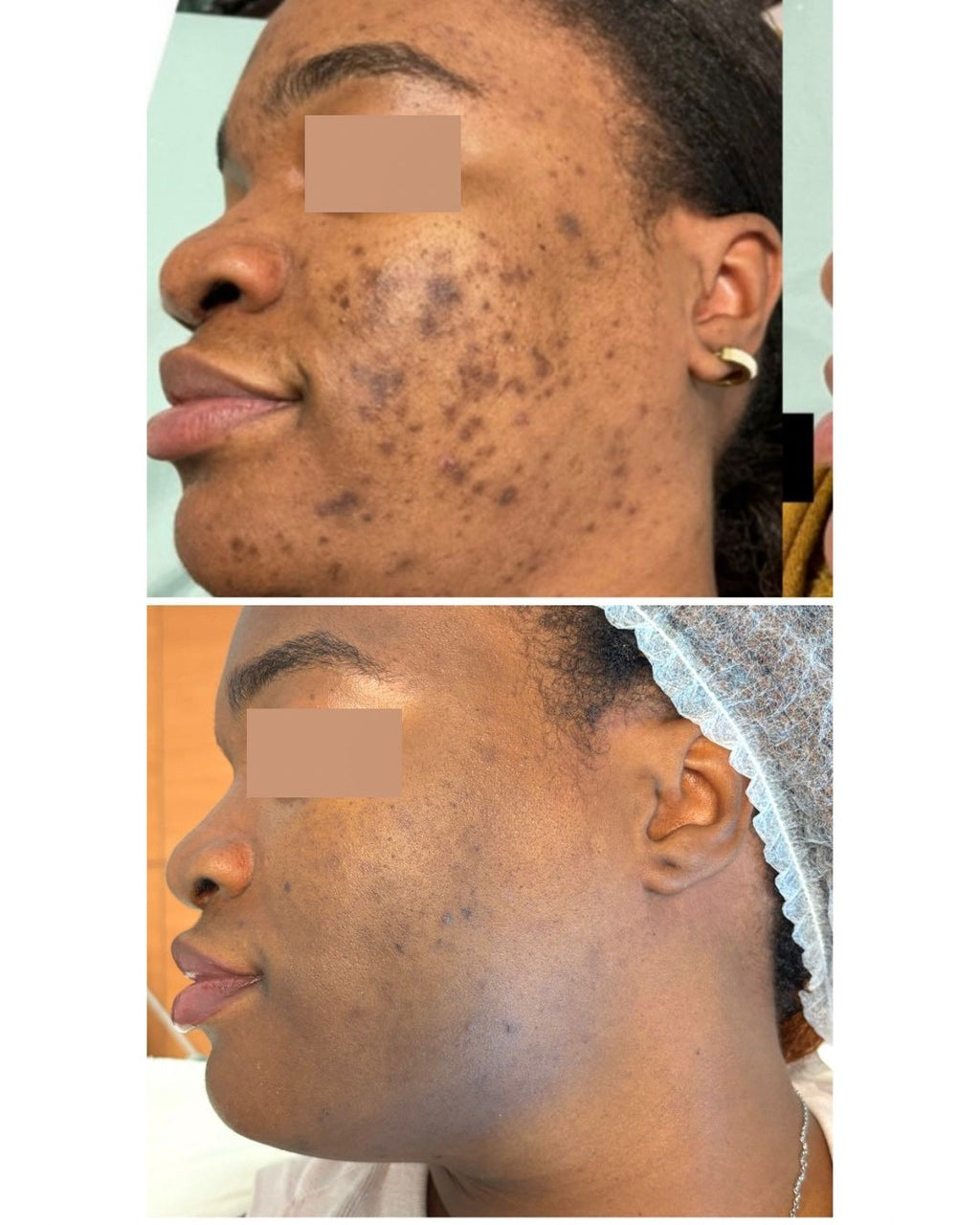 FORMAÇÃO PROFISSIONAL: PEELING PDA