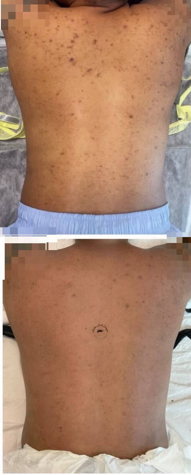 FORMAÇÃO PROFISSIONAL 3 EM 1: DERMAPEN, PEELING PDA, LIMPEZA FACIAL COMPLETA