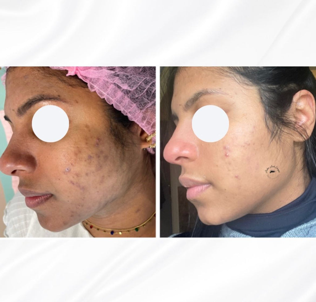 FORMAÇÃO PROFISSIONAL 3 EM 1: DERMAPEN, PEELING PDA, LIMPEZA FACIAL COMPLETA 2 DIAS