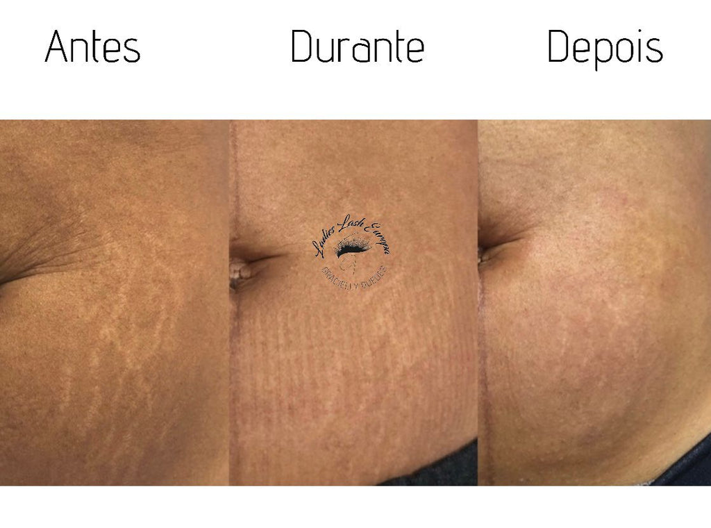 FORMAÇÃO PROFISSIONAL DERMAPEN: FACIAL E CORPORAL