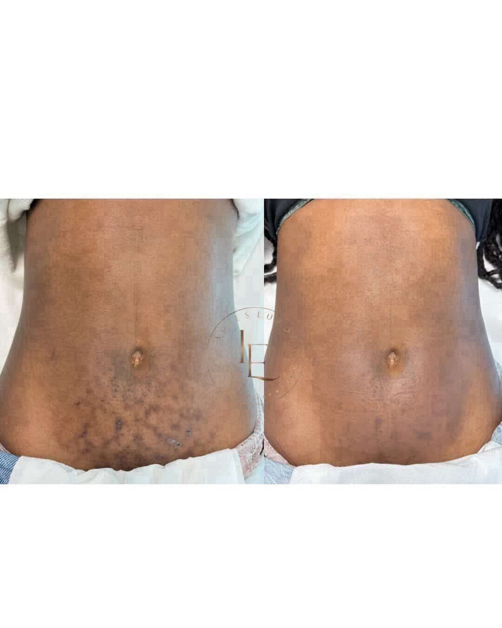 PROCEDIMENTO PARA MANCHAS 1 SESSÃO PEELING PDA