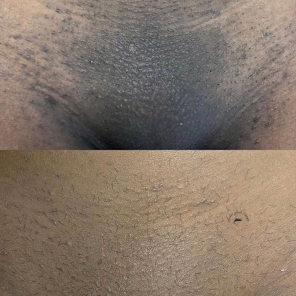 PROCEDIMENTO PARA MANCHAS 3 SESSÕES PEELING PDA
