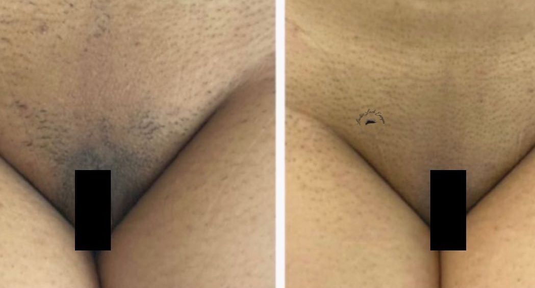 PROCEDIMENTO PARA MANCHAS 1 SESSÃO PEELING PDA