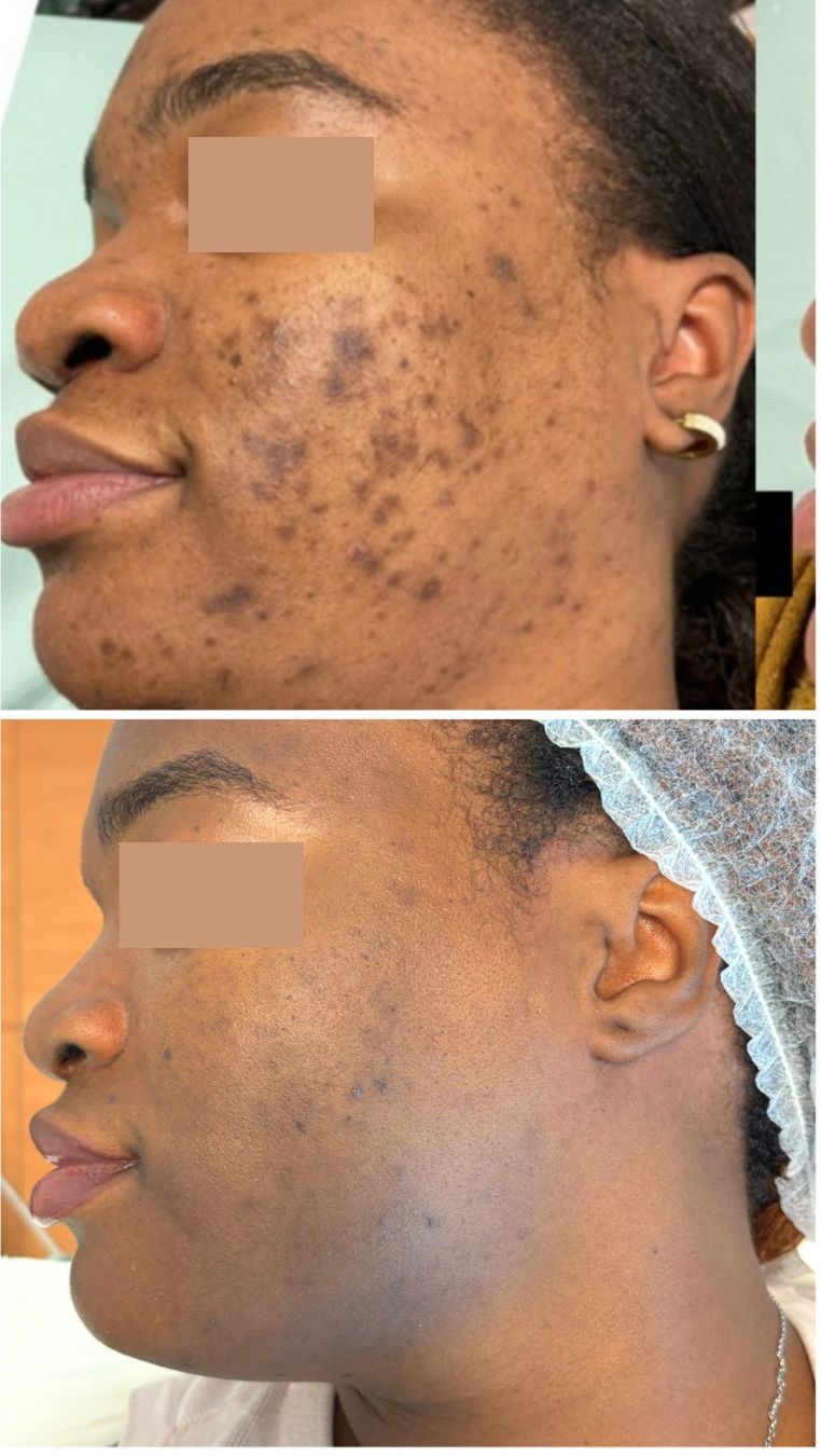 PROCEDIMENTO PARA MANCHAS 1 SESSÃO PEELING PDA