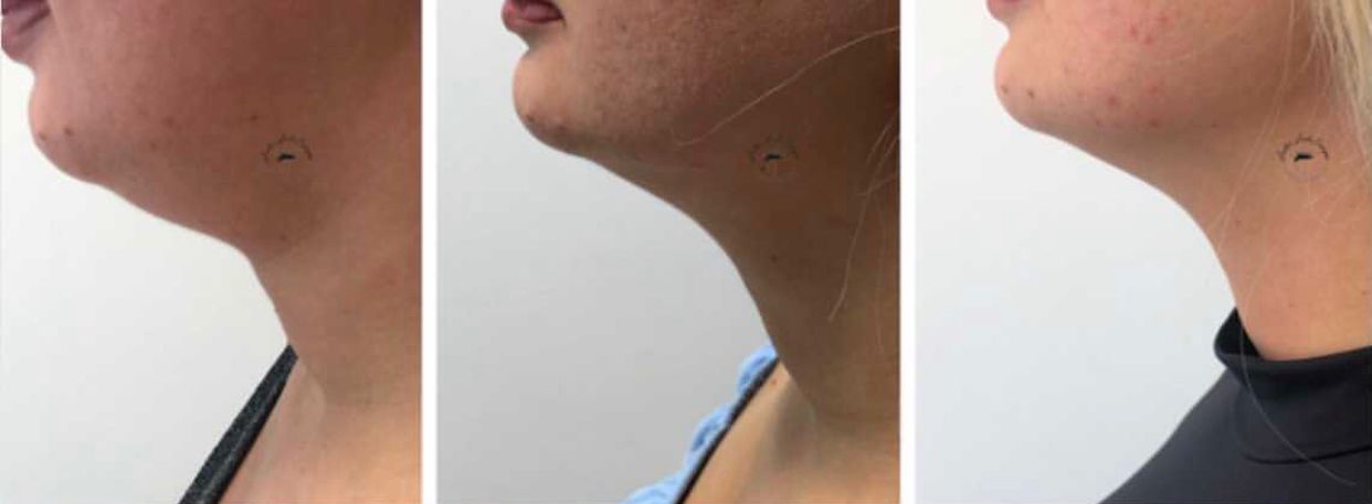 PROCEDIMENTO PAPADA OU BRAÇO 3 SESSÕES