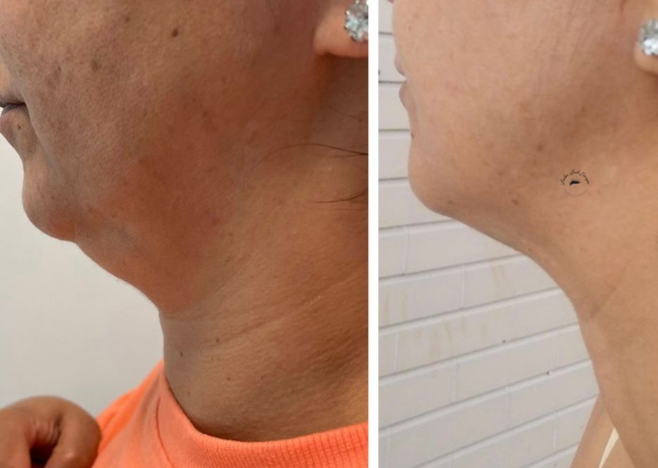 PROCEDIMENTO PAPADA OU BRAÇO 3 SESSÕES